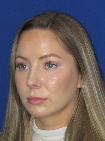 Rhinoplasty Before & After Gallery - Patient 177364 - Image 8