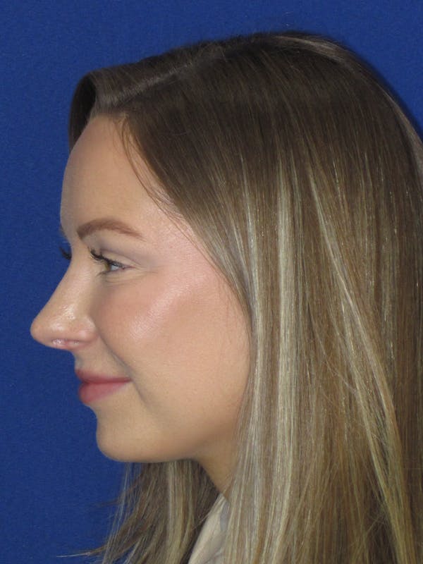 Rhinoplasty Before & After Gallery - Patient 177364 - Image 10