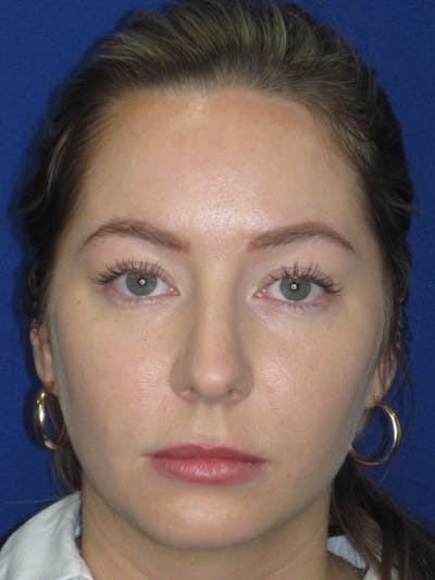 Rhinoplasty Before & After Gallery - Patient 177364 - Image 1