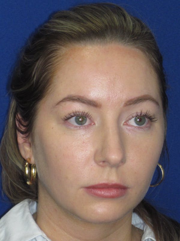 Rhinoplasty Before & After Gallery - Patient 177364 - Image 3