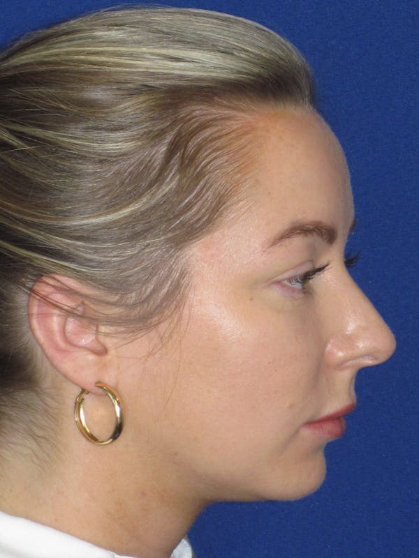 Rhinoplasty Before & After Gallery - Patient 177364 - Image 5