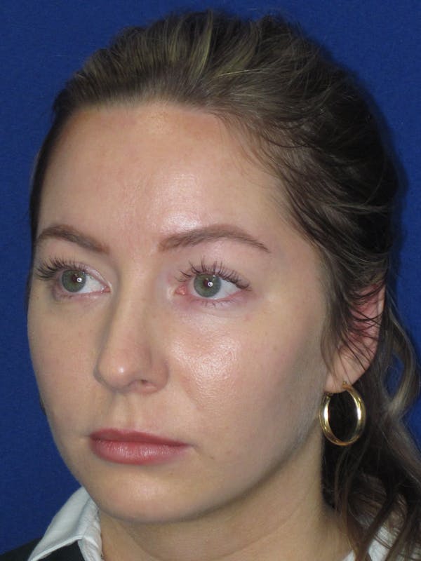 Rhinoplasty Before & After Gallery - Patient 177364 - Image 7