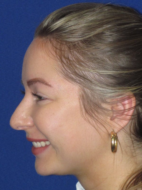 Rhinoplasty Before & After Gallery - Patient 177364 - Image 9