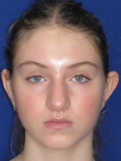 Rhinoplasty Before & After Gallery - Patient 282270 - Image 1