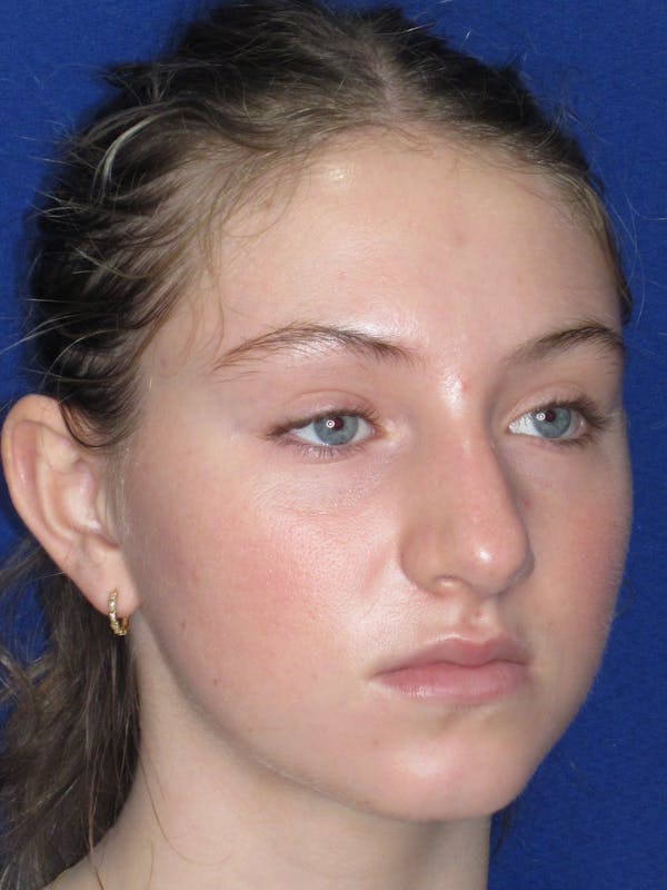 Rhinoplasty Before & After Gallery - Patient 282270 - Image 3