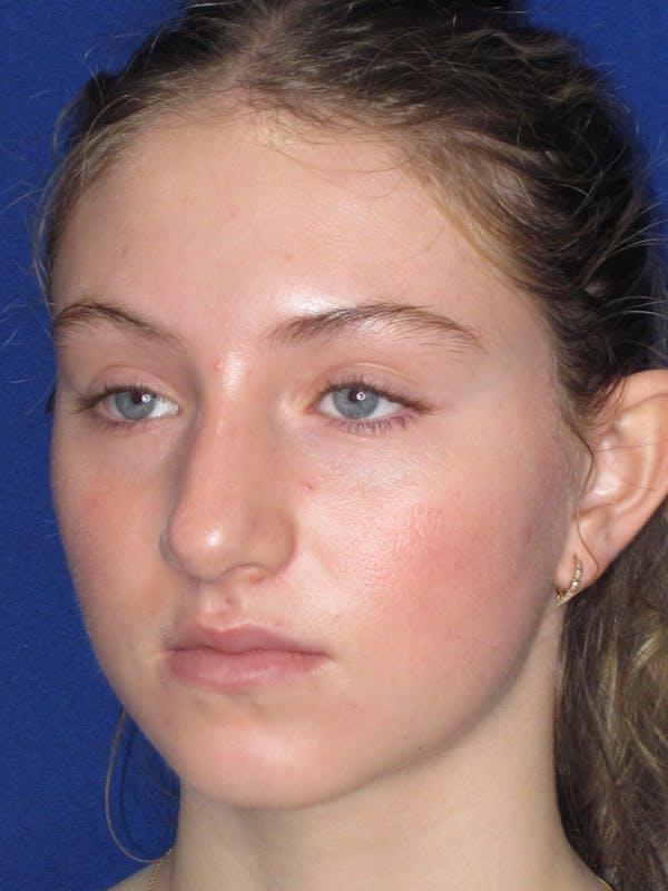 Rhinoplasty Before & After Gallery - Patient 282270 - Image 5