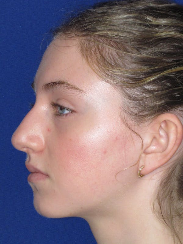 Rhinoplasty Before & After Gallery - Patient 282270 - Image 7