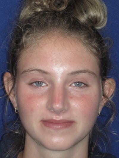 Rhinoplasty Before & After Gallery - Patient 282270 - Image 2