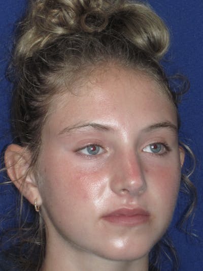Rhinoplasty Before & After Gallery - Patient 282270 - Image 4