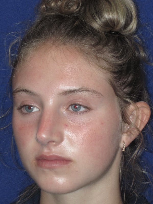 Rhinoplasty Before & After Gallery - Patient 282270 - Image 6