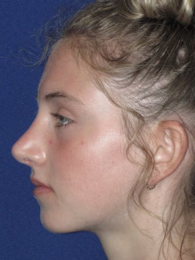 Rhinoplasty Before & After Gallery - Patient 282270 - Image 8