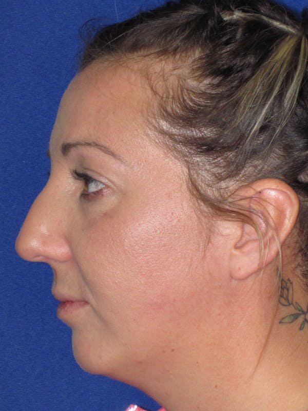 Rhinoplasty Before & After Gallery - Patient 330758 - Image 7
