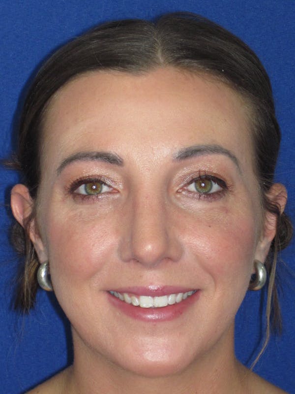 Rhinoplasty Before & After Gallery - Patient 330758 - Image 2