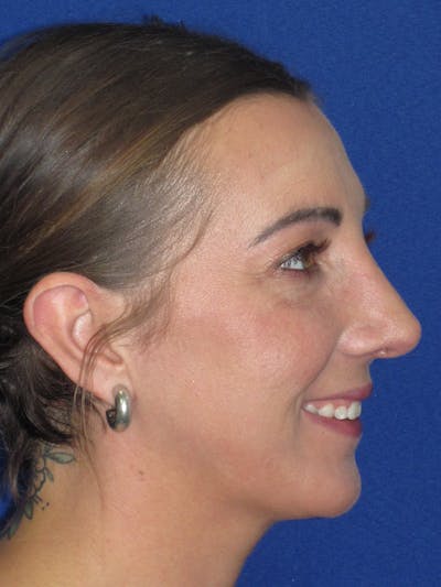 Rhinoplasty Before & After Gallery - Patient 330758 - Image 4