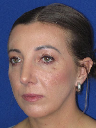 Rhinoplasty Before & After Gallery - Patient 330758 - Image 6