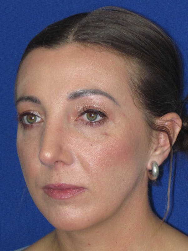 Rhinoplasty Before & After Gallery - Patient 330758 - Image 6