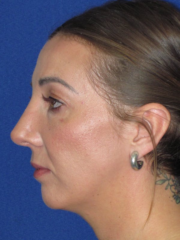 Rhinoplasty Before & After Gallery - Patient 330758 - Image 8