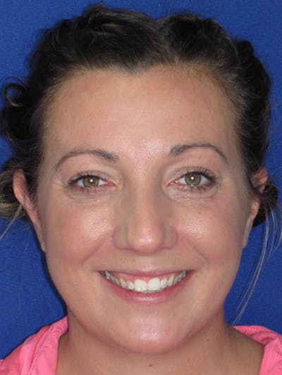 Rhinoplasty Before & After Gallery - Patient 330758 - Image 1