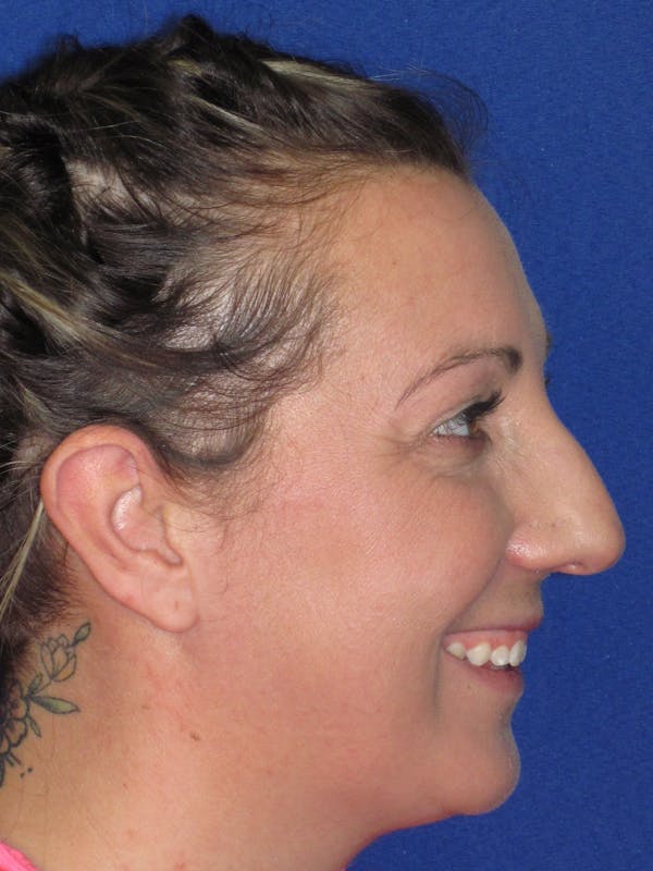 Rhinoplasty Before & After Gallery - Patient 330758 - Image 3