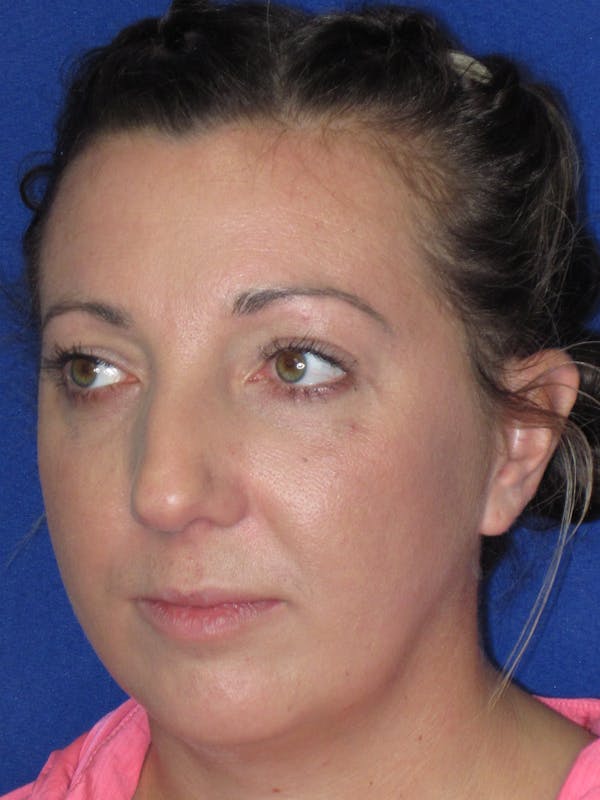 Rhinoplasty Before & After Gallery - Patient 330758 - Image 5