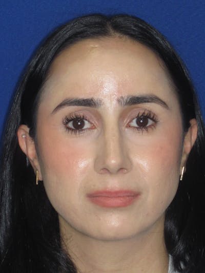 Rhinoplasty Before & After Gallery - Patient 147667 - Image 4