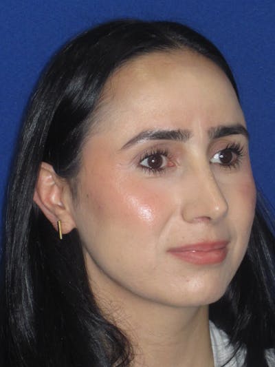 Rhinoplasty Before & After Gallery - Patient 147667 - Image 6