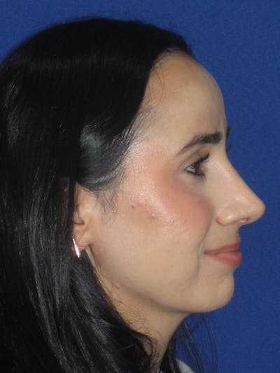 Rhinoplasty Before & After Gallery - Patient 147667 - Image 2