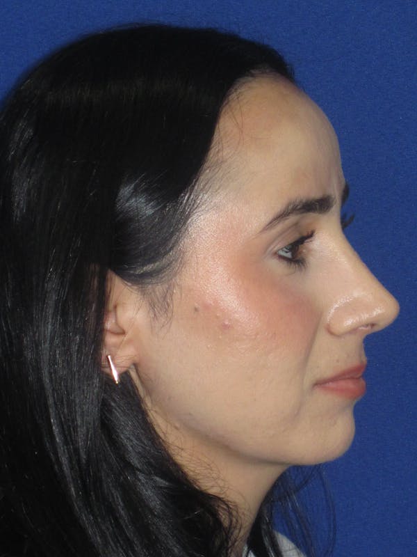 Rhinoplasty Before & After Gallery - Patient 147667 - Image 8