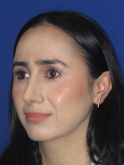 Rhinoplasty Before & After Gallery - Patient 147667 - Image 10
