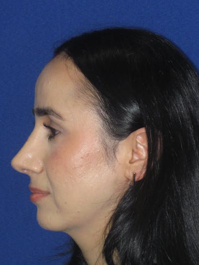 Rhinoplasty Before & After Gallery - Patient 147667 - Image 12