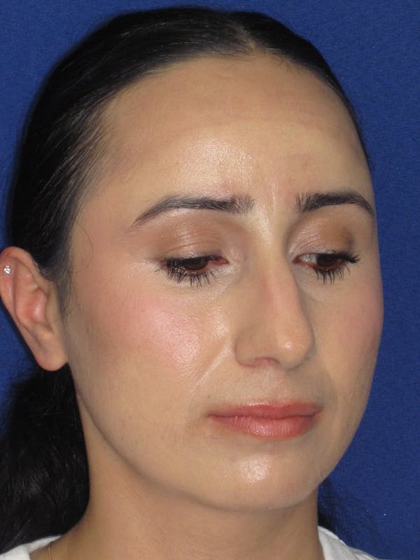 Rhinoplasty Before & After Gallery - Patient 147667 - Image 5