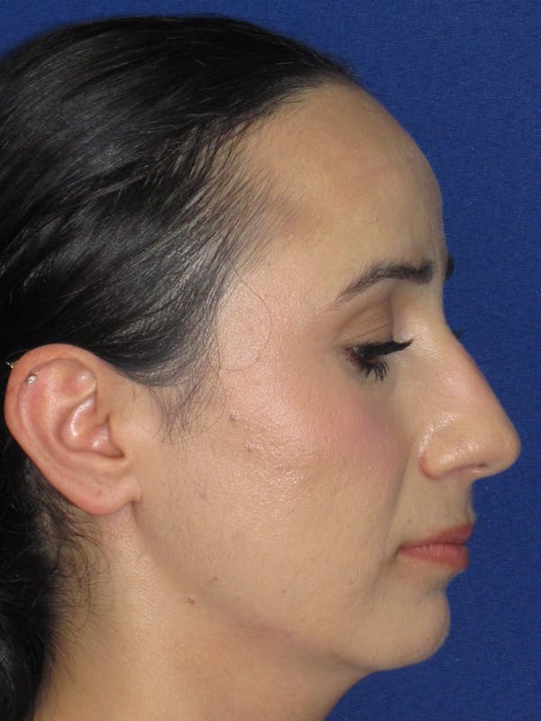 Rhinoplasty Before & After Gallery - Patient 147667 - Image 1