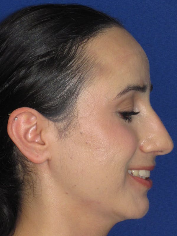Rhinoplasty Before & After Gallery - Patient 147667 - Image 7