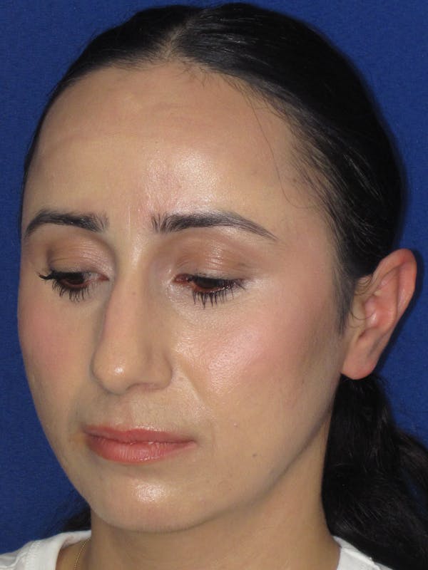Rhinoplasty Before & After Gallery - Patient 147667 - Image 9