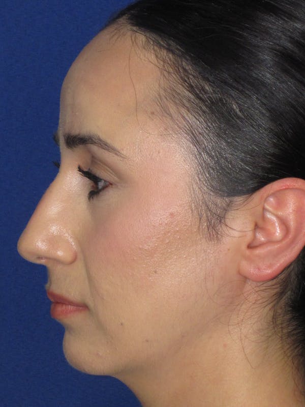 Rhinoplasty Before & After Gallery - Patient 147667 - Image 11