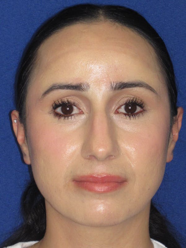 Rhinoplasty Before & After Gallery - Patient 147667 - Image 3