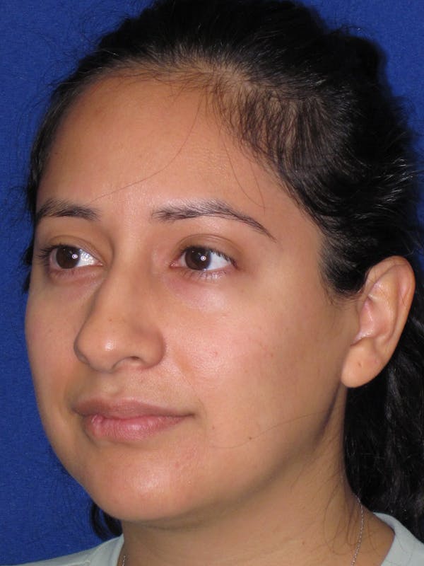Rhinoplasty Before & After Gallery - Patient 247787 - Image 11