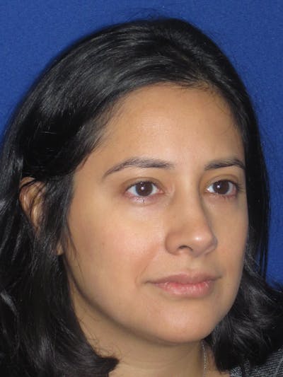 Rhinoplasty Before & After Gallery - Patient 247787 - Image 6