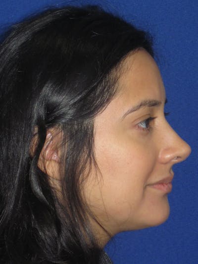 Rhinoplasty Before & After Gallery - Patient 247787 - Image 8