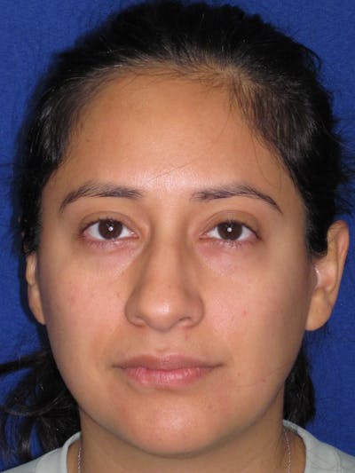 Rhinoplasty Before & After Gallery - Patient 247787 - Image 1