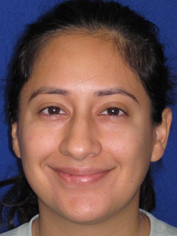 Rhinoplasty Before & After Gallery - Patient 247787 - Image 3