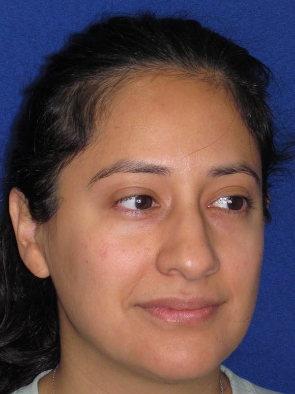 Rhinoplasty Before & After Gallery - Patient 247787 - Image 5