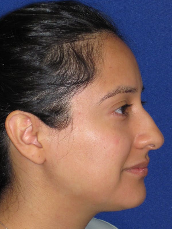 Rhinoplasty Before & After Gallery - Patient 247787 - Image 7