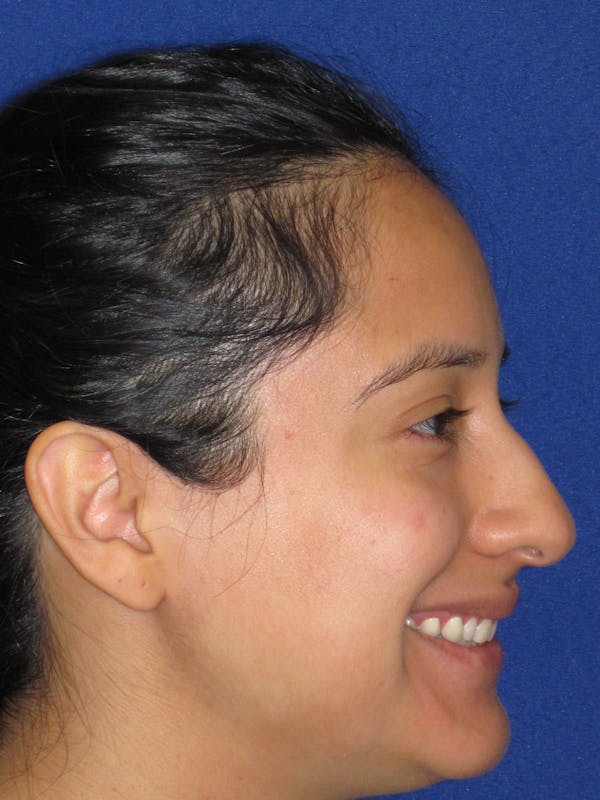 Rhinoplasty Before & After Gallery - Patient 247787 - Image 9