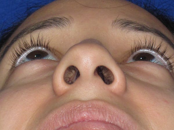 Rhinoplasty Before & After Gallery - Patient 247787 - Image 13