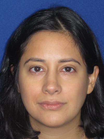 Rhinoplasty Before & After Gallery - Patient 247787 - Image 2