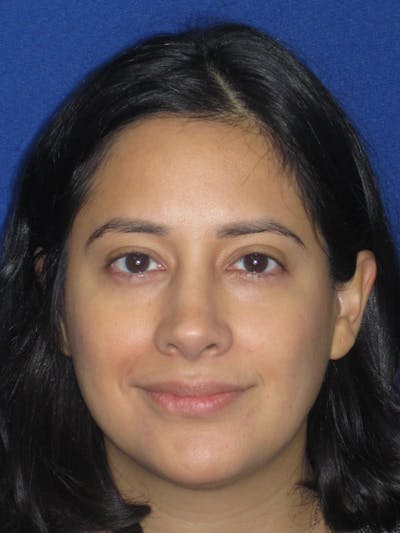 Rhinoplasty Before & After Gallery - Patient 247787 - Image 4