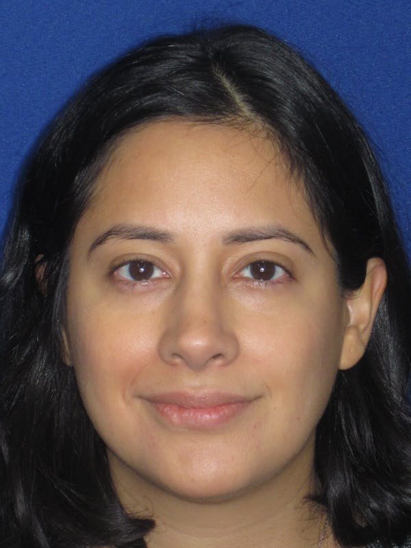 Rhinoplasty Before & After Gallery - Patient 247787 - Image 4
