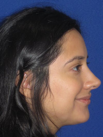 Rhinoplasty Before & After Gallery - Patient 247787 - Image 10