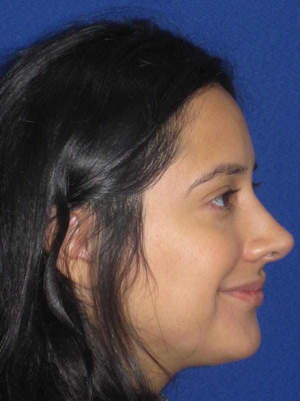 Rhinoplasty Before & After Gallery - Patient 247787 - Image 10